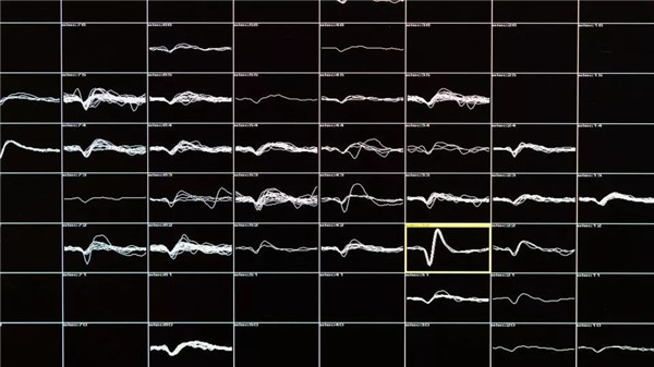 在大腦中植入100根電極后,失明16年的患者重見光明 在大腦中植入100根電極后,失明16年的患者重見光明